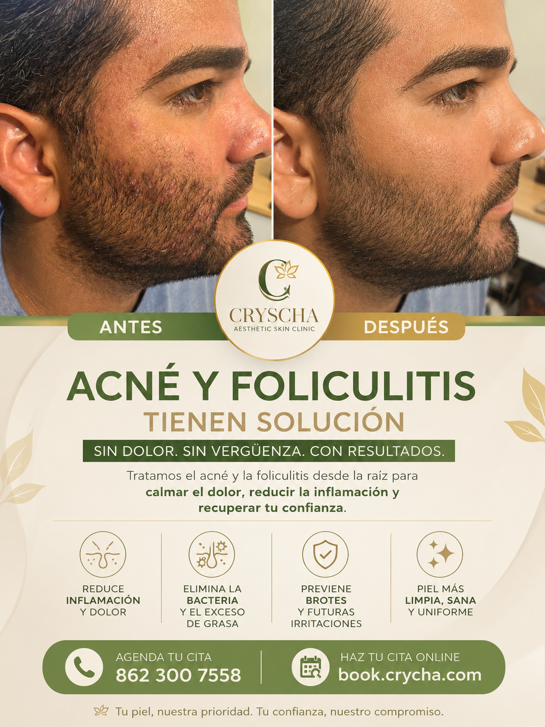 foliculitis,acne hombre